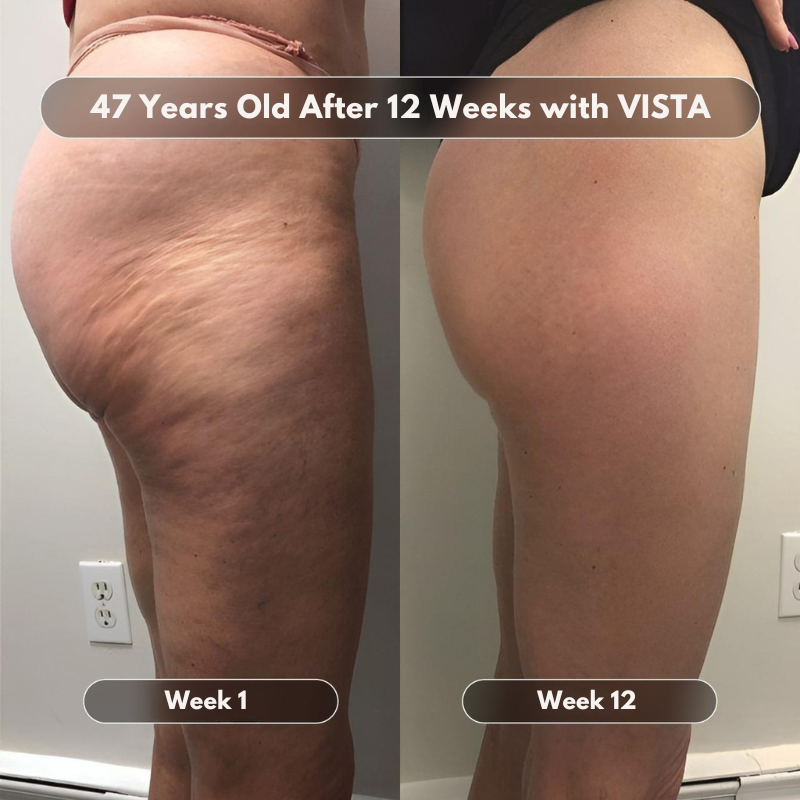 VISTA Anti-Cellulite Massage Oil